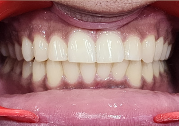Invisalign – Aligners – Braces - After